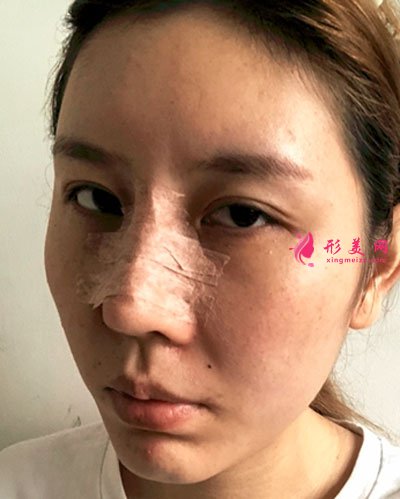 成都菲格隆鼻手術案例