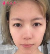 北京八大處靳小雷隆鼻案例分享，術(shù)后效果真實(shí)！
