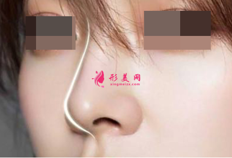 假體隆鼻手術(shù)會影響呼吸嗎