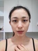 北京八大處魏建軍做皮秒怎么樣？術(shù)后30天換了一張臉