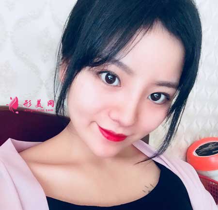 鼻綜合整形術(shù)后20天