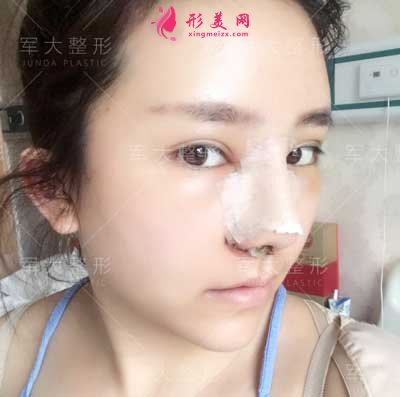 鼻綜合整形手術(shù)后