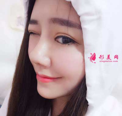鼻綜合整形術(shù)后15天