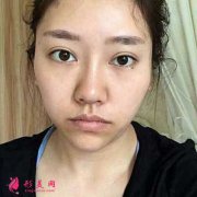 成都軍大做的鼻綜合整形，我也能輕松擁有小翹鼻了