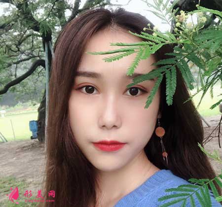 眼綜合整形術(shù)后90天