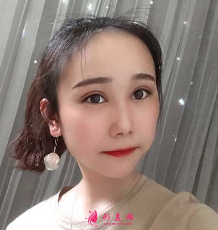 眼綜合整形術(shù)后50天