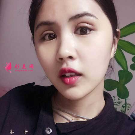 全切雙眼皮術(shù)后15天