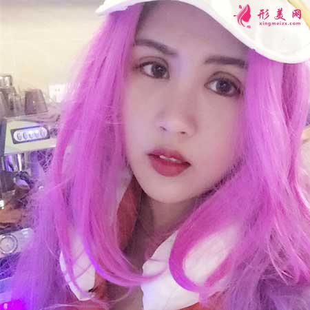全切雙眼皮術(shù)后一個(gè)月