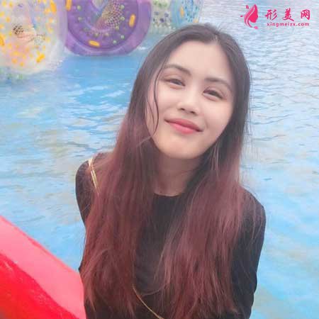 全切雙眼皮術(shù)后50天