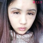 成都軍大整容醫(yī)院做的全切雙眼皮手術(shù)，眼睛又大又有神