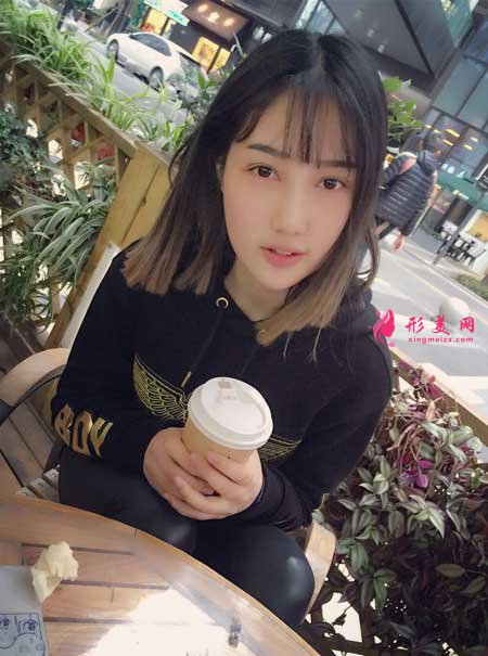 雙眼皮修復(fù)術(shù)后20天