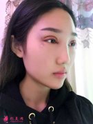 成都軍大整容醫(yī)院做的雙眼皮修復(fù)，整張臉都飽滿了