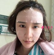 成都軍大做的自體脂肪面部填充，讓我重返18歲
