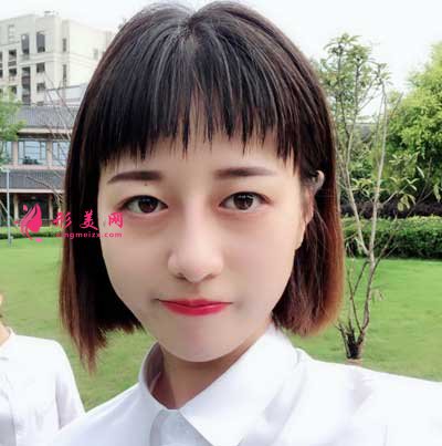 鼻綜合整形術后60天