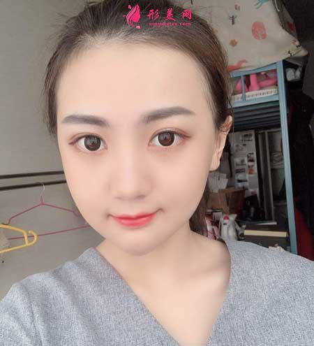 下頜角+顴骨顴弓手術(shù)術(shù)后30天