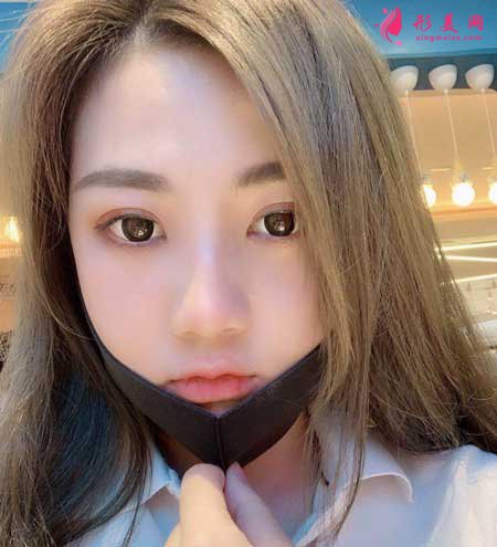 下頜角+顴骨顴弓手術(shù)術(shù)后100天