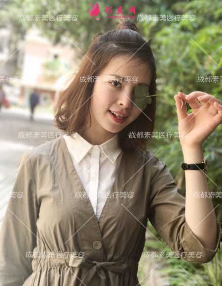 膨體鼻綜合隆鼻手術(shù)后25天