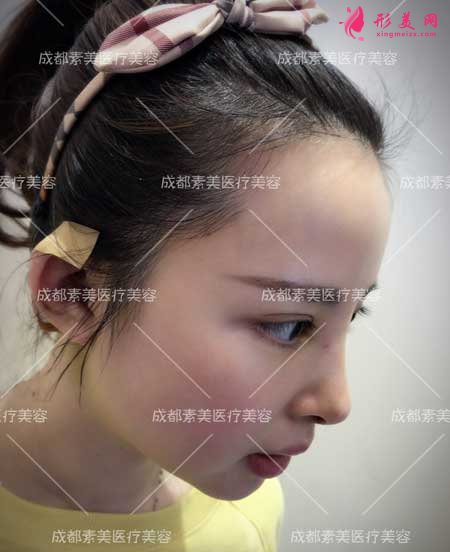 膨體鼻綜合隆鼻手術(shù)后7天