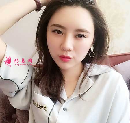 自體脂肪面部填充術(shù)后半個月