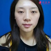 廣州華美做自體脂肪面部填充，2個(gè)月恢復(fù)美麗日記