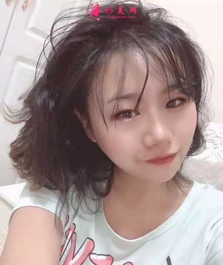 熱拉提手術后