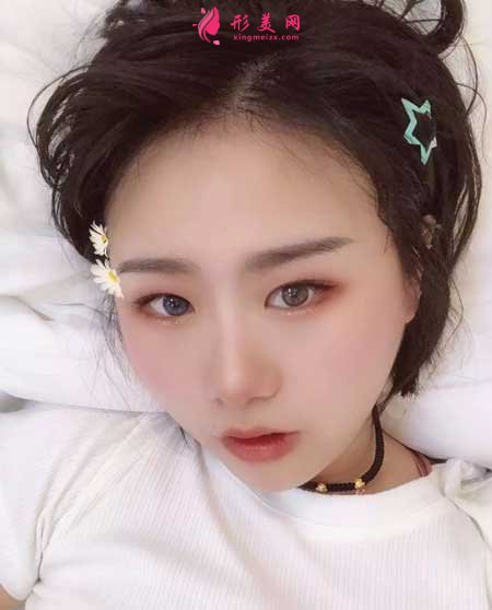 熱拉提手術后40天
