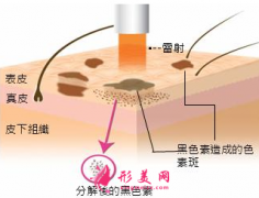 孕期可以做激光祛黃褐斑嗎？