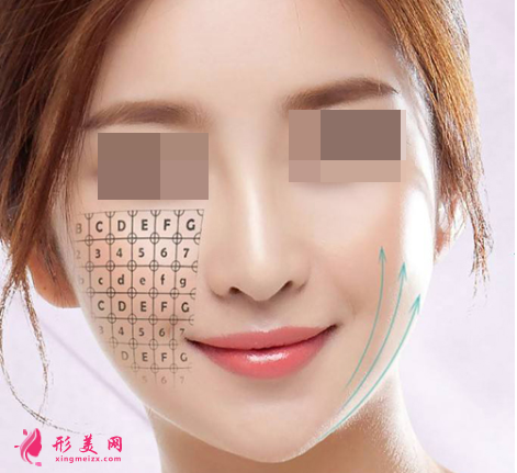 埋線提升后要休息多久