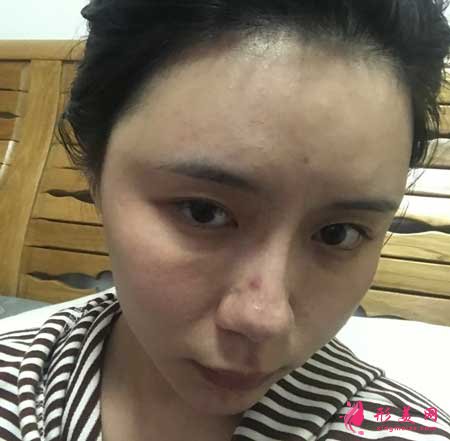 自體脂肪面部填充手術后15天