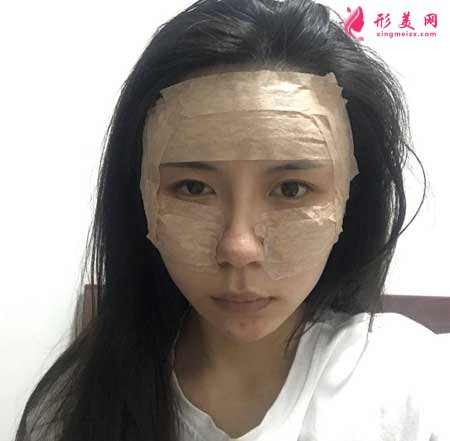 自體脂肪面部填充手術后7天