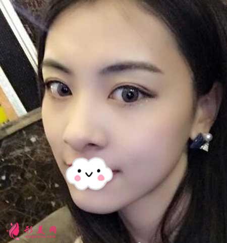 重慶華美李瑞琦做埋線提升手術(shù)后1個月