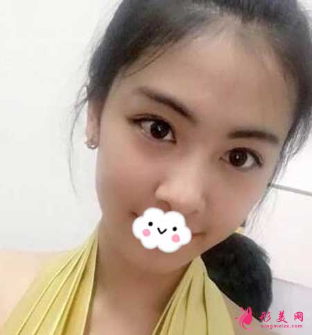 重慶華美李瑞琦做埋線提升手術(shù)后