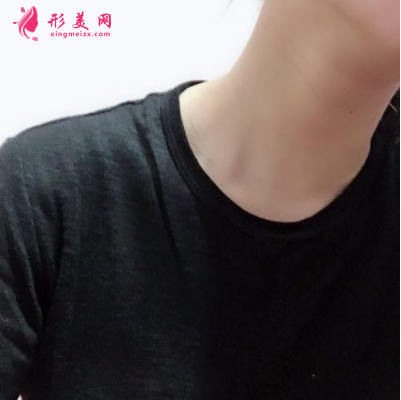 深圳藝星朱輝去除頸紋