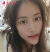 上海九院整形科隆鼻案例術(shù)后恢復(fù)過(guò)程反饋圖分享