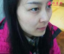 北京八大處楊明勇做雙眼皮案例！說說做眼睛整形的心理感受！