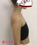 上海九院曹衛(wèi)剛抽脂隆胸怎么樣？真人案例一覽