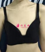上海九院隆胸怎么樣？看曹衛(wèi)剛醫(yī)生自體脂肪隆胸案例！