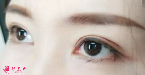 做埋線雙眼皮后會被看出來嗎