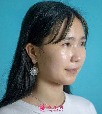 武漢美亞整形醫(yī)院劉佳亮雙眼皮