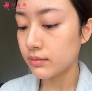 武漢美亞整形醫(yī)院謝大明面部除皺，術(shù)后讓我保持好狀態(tài)