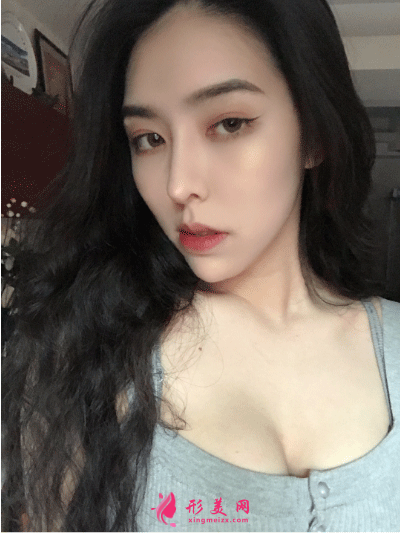隆胸一個(gè)月后