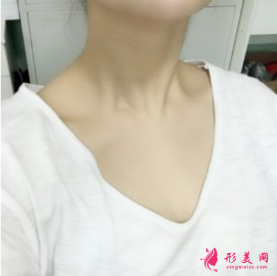 深圳藝星朱輝去除頸紋