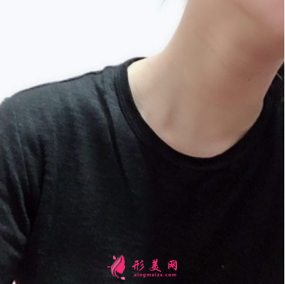 深圳藝星朱輝去除頸紋