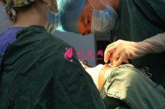 深圳江南春天李剛隆鼻技術(shù)如何?真實案例分享