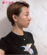深圳銘醫(yī)劉昕做雙眼皮的效果好不好?