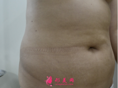 深圳非凡整形醫(yī)院腰部吸脂案例分享，水桶腰輕松變身小蠻腰