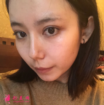 深圳非凡整形醫(yī)院梅夠明隆鼻手術(shù)