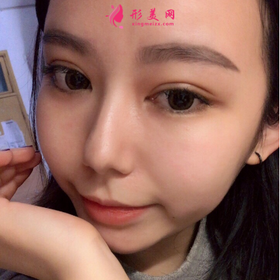 深圳非凡整形醫(yī)院梅夠明隆鼻手術(shù)