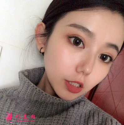 深圳非凡整形醫(yī)院梅夠明隆鼻手術(shù)