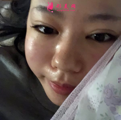深圳非凡整形醫(yī)院梅夠明隆鼻手術(shù)